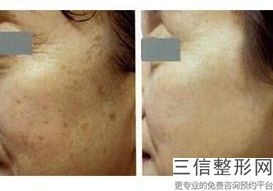 成都热玛吉在国内授权的机构排行榜前三被娇点,中国热玛吉总代理是哪家公司