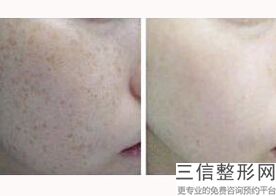 成都热玛吉在国内授权的机构排行榜前三被娇点,中国热玛吉总代理是哪家公司