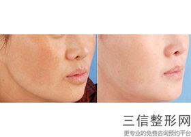 成都热玛吉在国内授权的机构排行榜前三被娇点,中国热玛吉总代理是哪家公司