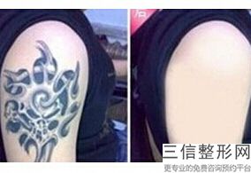 成都热玛吉在国内授权的机构排行榜前三被娇点,中国热玛吉总代理是哪家公司