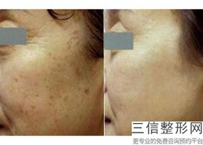 成都热玛吉在国内授权的机构排行榜前三被娇点,中国热玛吉总代理是哪家公司
