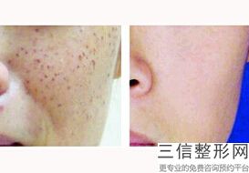 成都三甲医院有正规授权的热玛吉吗,成都哪家医院做热玛吉好