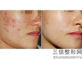 成都三甲医院有正规授权的热玛吉吗,成都哪家医院做热玛吉好
