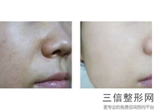 成都三甲医院有正规授权的热玛吉吗,成都哪家医院做热玛吉好
