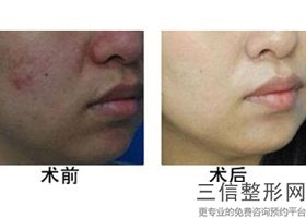 成都三甲医院做拉皮手术口碑排行榜前十,三甲医院做拉皮哪家好