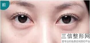 成都有名的割双眼皮医院排行榜,成都名次靠前的割双眼皮医院