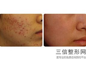 大连热玛吉正规授权医院排行公布,大连哪家医院有热玛吉