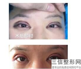 大连整形医院做双眼皮哪家比较好,大连割双眼皮哪家好