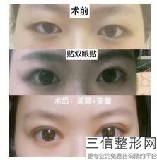 佛山眼部手术整形医院排行榜权威发布,佛山有哪些整形医院