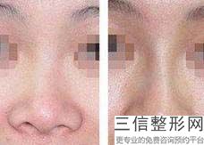 福州鼻整形医院排名榜前六权威点评,福州隆鼻医院好