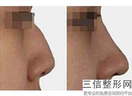 福州鼻整形医院排名榜前六权威点评,福州隆鼻医院好