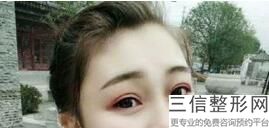 福州割双眼皮省立好还是附一,福州割双眼皮价格