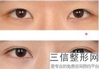 福州割双眼皮省立好还是附一,福州割双眼皮价格