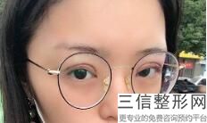 福州割双眼皮省立好还是附一,福州割双眼皮价格