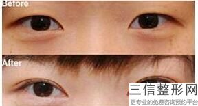 福州全切双眼皮整形医院排名前五靠谱推荐,福州什么医院割双眼皮比较好