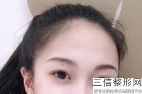 福州全切双眼皮整形医院排名前五靠谱推荐,福州什么医院割双眼皮比较好