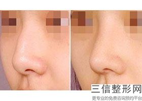 福州市三甲医院有做隆鼻吗,福州哪个医院做鼻子好