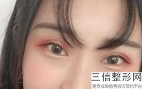 福州双眼皮整形医院排行榜十强评选已出,福州双眼皮三甲医院