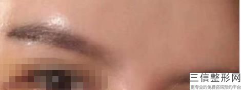 福州做双眼皮医院排行前十实名出炉,福州公立医院双眼皮