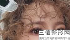 福州做双眼皮医院排名榜在线给你们推荐,福州哪家医院割双眼皮比较好