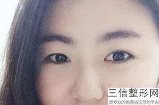 福州做双眼皮医院排名榜在线给你们推荐,福州哪家医院割双眼皮比较好