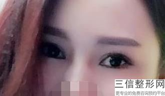 福州做双眼皮医院排名榜在线给你们推荐,福州哪家医院割双眼皮比较好