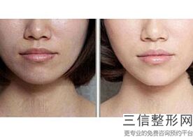 公开上海做热玛吉美容整形医院排名前十详情,整形医院的热玛吉