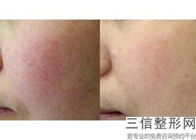公开上海做热玛吉美容整形医院排名前十详情,整形医院的热玛吉