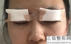 别滑走这份济南做双眼皮正规医院排行榜,济南双眼皮整形