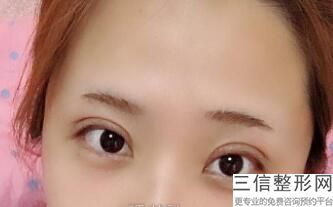 别滑走这份济南做双眼皮正规医院排行榜,济南双眼皮整形