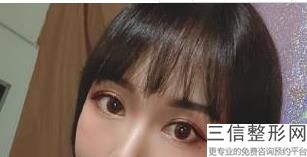 别滑走这份济南做双眼皮正规医院排行榜,济南双眼皮整形