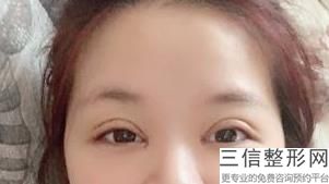 常德市做双眼皮整形医院排行榜前五,常德割双眼皮比较有名的医生