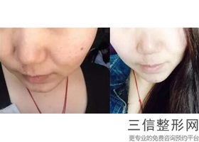 潮州热玛吉官方授权医院名单介绍,汕头热玛吉官方授权医院