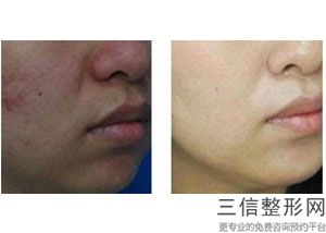 郴州热玛吉正规授权认证医院排名分享,重庆热玛吉官方认证医院
