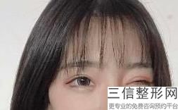 成都优秀修复双眼皮医院排名前三,成都比较出名双眼皮修复医生