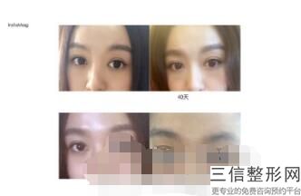 成都优秀修复双眼皮医院排名前三,成都比较出名双眼皮修复医生