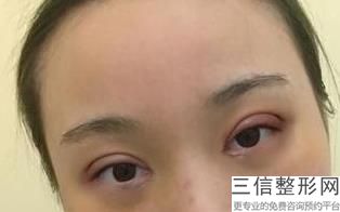 成都优秀修复双眼皮医院排名前三,成都比较出名双眼皮修复医生