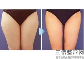成都丰胸整形医院排名榜top5权威攻略,成都胸部整形哪家医院良好