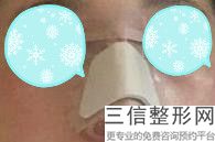 成都隆鼻手术整形医院排名前十权威评点,成都哪家医院隆鼻子良好的医院