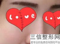 成都隆鼻手术整形医院排名前十权威评点,成都哪家医院隆鼻子良好的医院