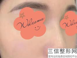 成都哪家整形医院隆鼻效果好,成都哪家整形医院鼻子整形良好