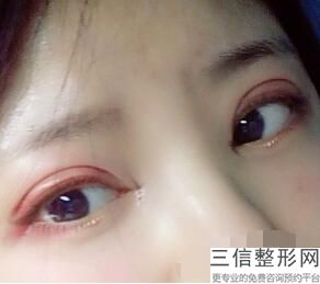 成都排名前十的割双眼皮医生排行榜公选出炉,成都双眼皮专家排名