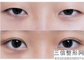 成都排名前十的割双眼皮医生排行榜公选出炉,成都双眼皮专家排名
