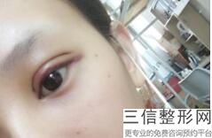 成都排名前十的割双眼皮医生排行榜公选出炉,成都双眼皮专家排名
