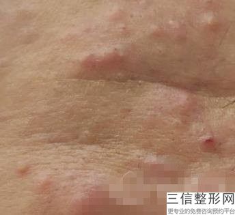 成都热玛吉官方授权医院排名榜top5盘点,成都5代热玛吉哪家医院是授权的官网