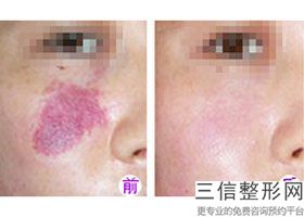 成都热玛吉认证医院排行榜top5实力盘点,成都热玛吉官网认证医院