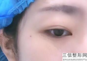 成都双眼皮全切整形医院排名前五,成都哪家医院割双眼皮好