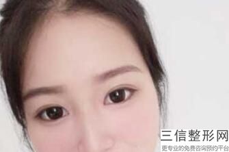 成都双眼皮全切整形医院排名前五,成都哪家医院割双眼皮好