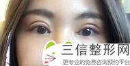 成都双眼皮修复医院推荐排行前十硬核发布,成都双眼皮口碑良好的整容医院