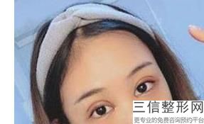 成都眼部整形医生排名榜前十,成都眼睛整形什么医院良好